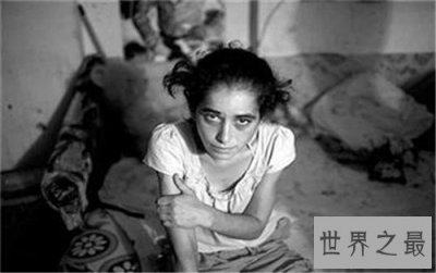 ​世界上最早被发现的艾滋病,从美国发现的瘟疫之源