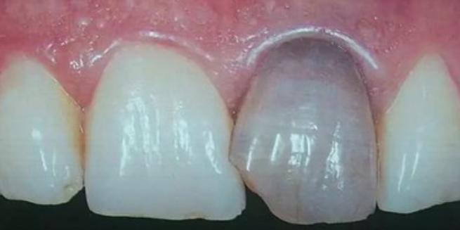 牙齿上出现这种“小黑点”，你要注意了，基本能毁掉整颗牙！