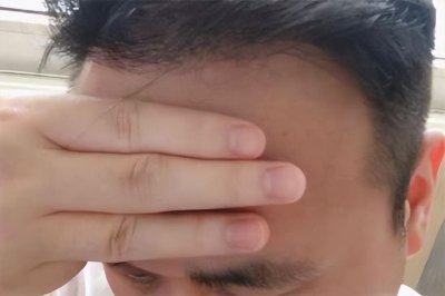 ​正常发际线是几根手指 正常发际线在哪个位置