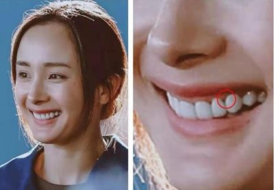 ​5位烤瓷牙明星，有的牙龈变灰，有的嘴包不住牙，一个比一个惨