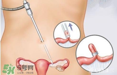 女人怎样避孕最安全？对女人最好的避孕方法