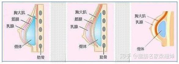 隆胸有哪几种方式,隆胸哪种方式比较好呀