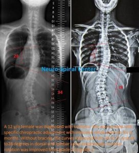 ​脊椎侧弯正确的锻炼与活动方法，附案例图！