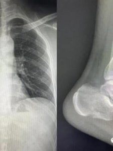 ​x光片能检查什么