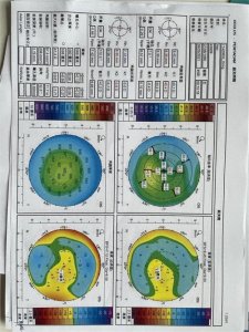 ​犹豫了两年之后，我终于做了全飞秒近视矫正手术，还是有点后悔的